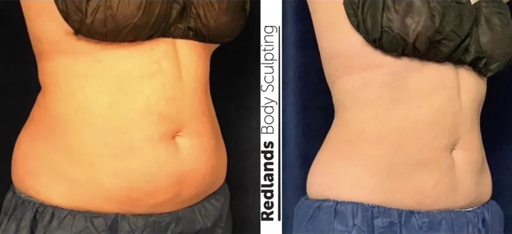 CoolSculpting Before and After photo by Redlands Body Sculpting in Redlands, CA