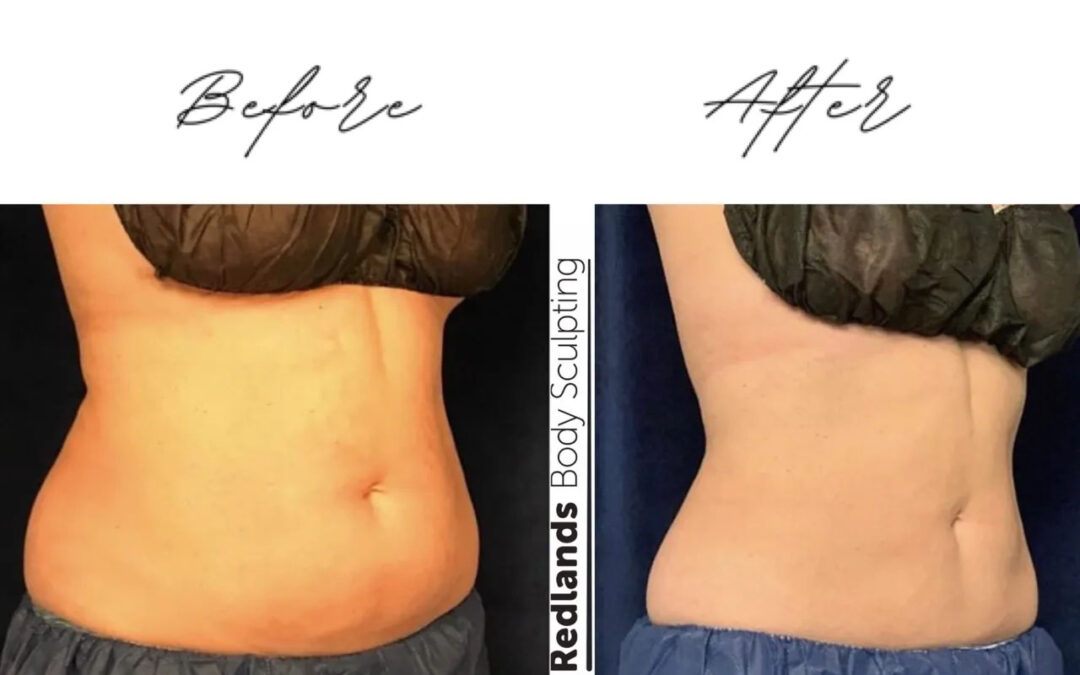 before and after abdomen coolsculpting treatment at RedLands Body Sculpting with Dr. Aya in California