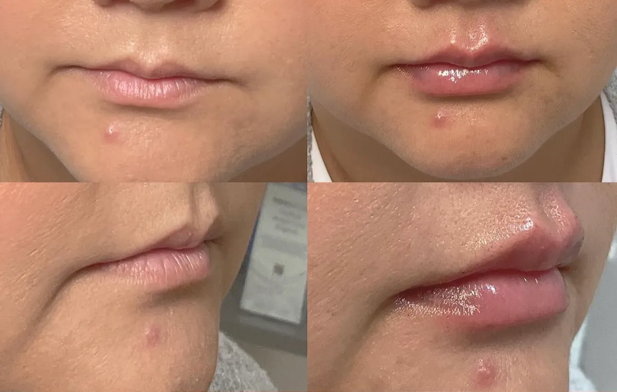 before and after injectables treatment at RedLands Body Sculpting with Dr. Aya in California