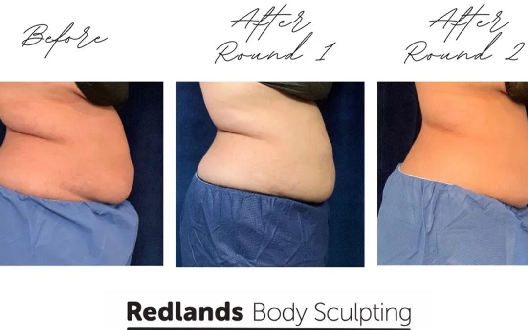before and after love handles back coolsculpting treatment at RedLands Body Sculpting with Dr. Aya in California