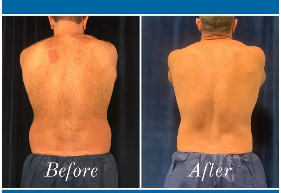before and after abdomen coolsculpting treatment at RedLands Body Sculpting with Dr. Aya in California