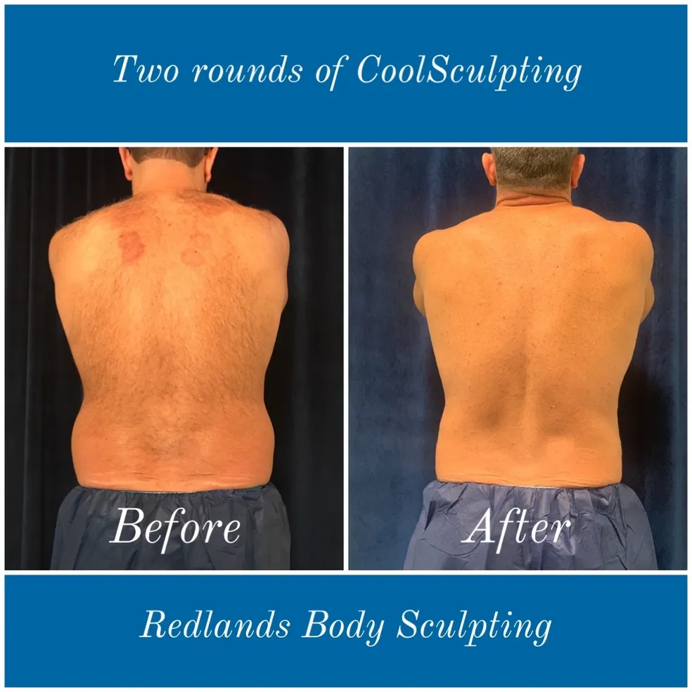 before and after abdomen coolsculpting treatment at RedLands Body Sculpting with Dr. Aya in California