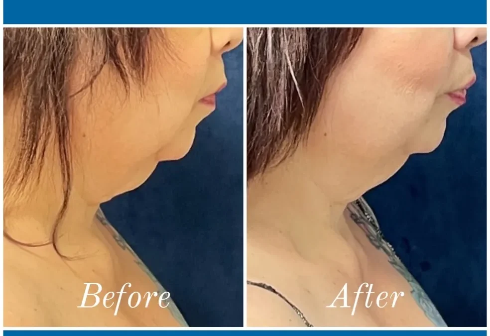 before and after abdomen coolsculpting treatment at RedLands Body Sculpting with Dr. Aya in California