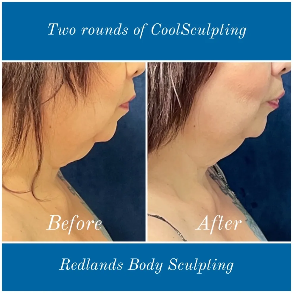 before and after abdomen coolsculpting treatment at RedLands Body Sculpting with Dr. Aya in California