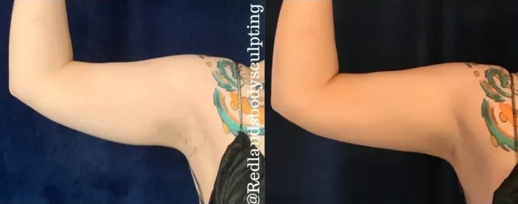 CoolSculpting Before and After photo by Redlands Body Sculpting in Redlands, CA