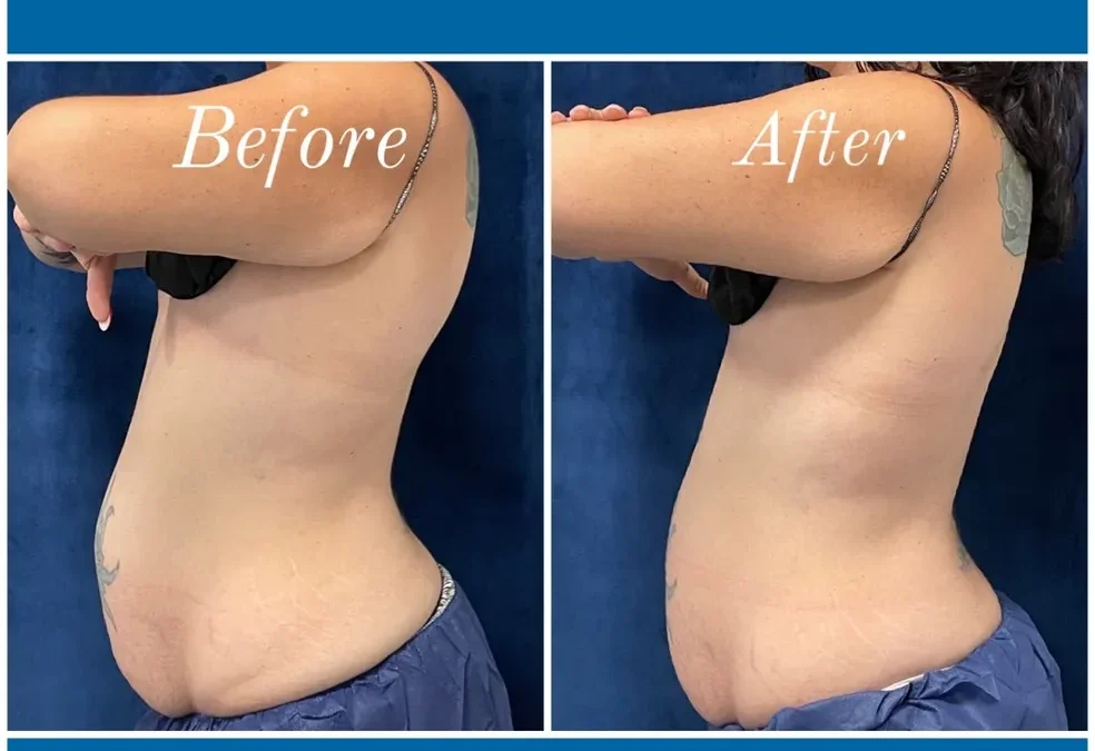 before and after abdomen coolsculpting treatment at RedLands Body Sculpting with Dr. Aya in California