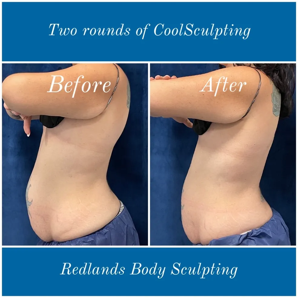 before and after abdomen coolsculpting treatment at RedLands Body Sculpting with Dr. Aya in California