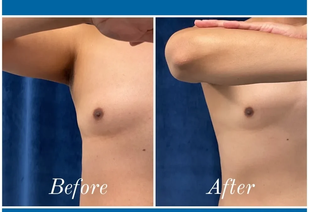 before and after abdomen coolsculpting treatment at RedLands Body Sculpting with Dr. Aya in California