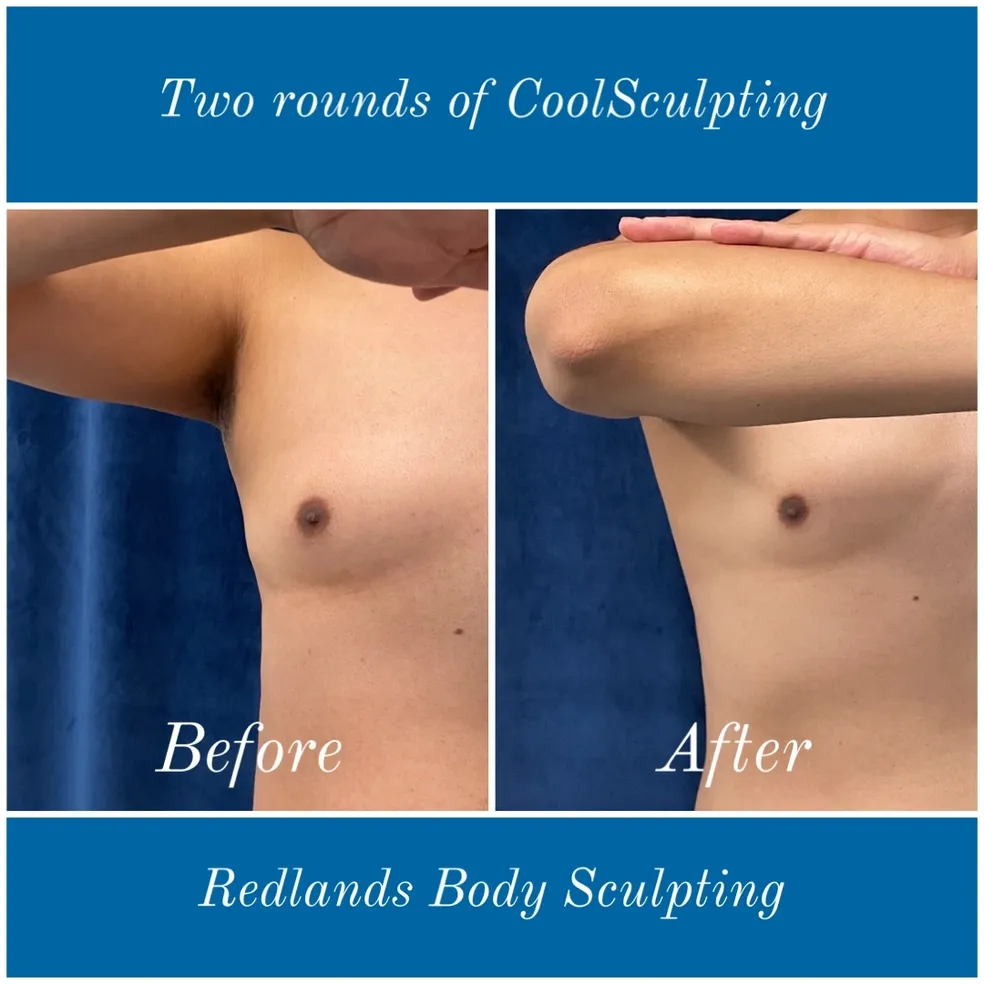 before and after abdomen coolsculpting treatment at RedLands Body Sculpting with Dr. Aya in California
