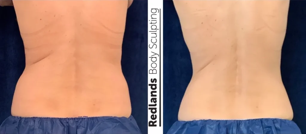 CoolSculpting Before and After photo by Redlands Body Sculpting in Redlands, CA