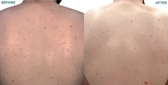VI Peel Body Before and After photo by Redlands Body Sculpting in Redlands, CA