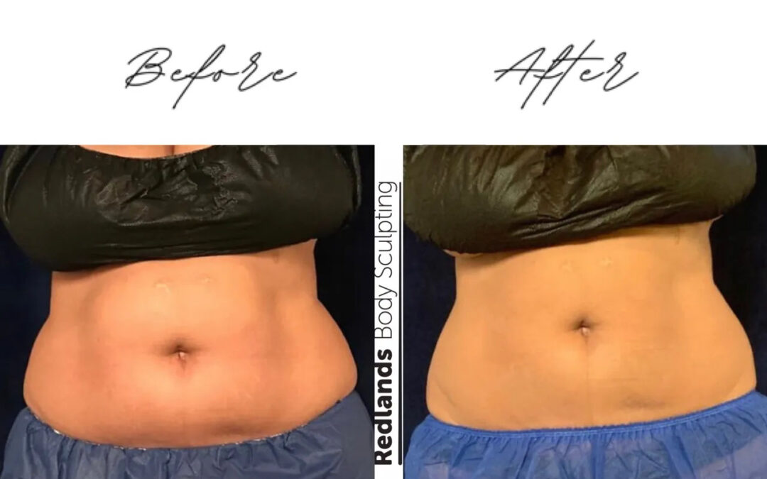 before and after abdomen coolsculpting treatment at RedLands Body Sculpting with Dr. Aya in California