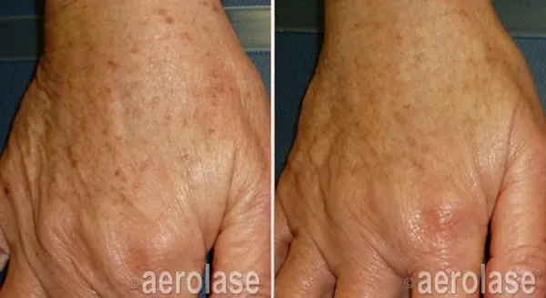 before and after aerolase laser treatment at RedLands Body Sculpting with Dr. Aya in California