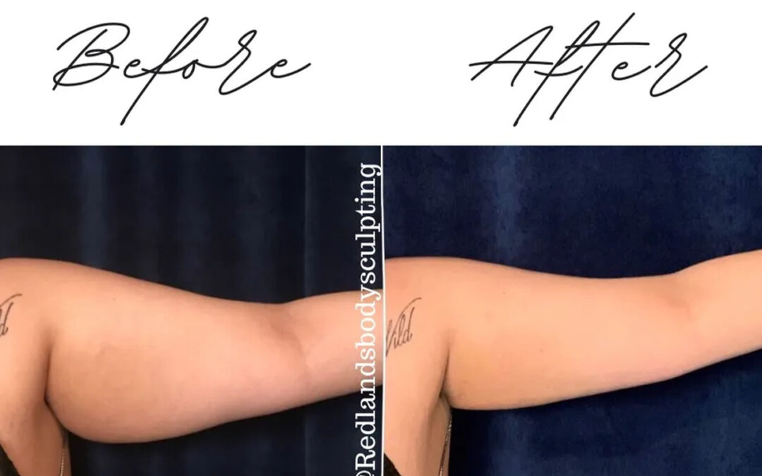 before and after arm coolsculpting treatment at RedLands Body Sculpting with Dr. Aya in California