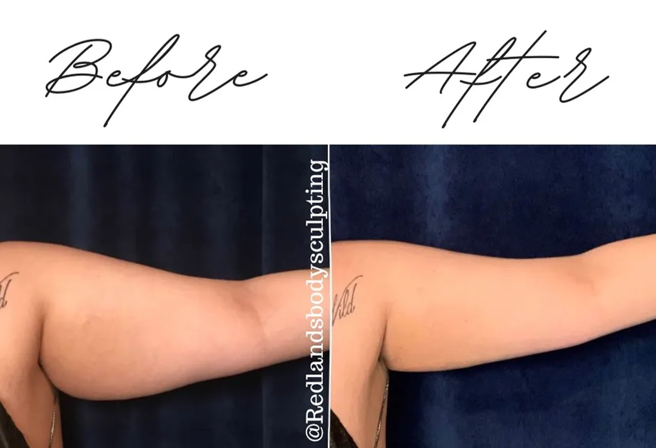 before and after arm coolsculpting treatment at RedLands Body Sculpting with Dr. Aya in California