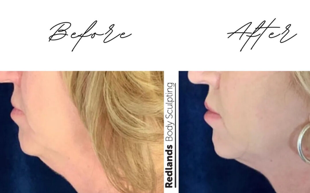 before and after chin coolsculpting treatment at RedLands Body Sculpting with Dr. Aya in California