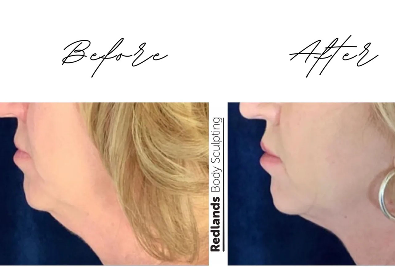 before and after chin coolsculpting treatment at RedLands Body Sculpting with Dr. Aya in California