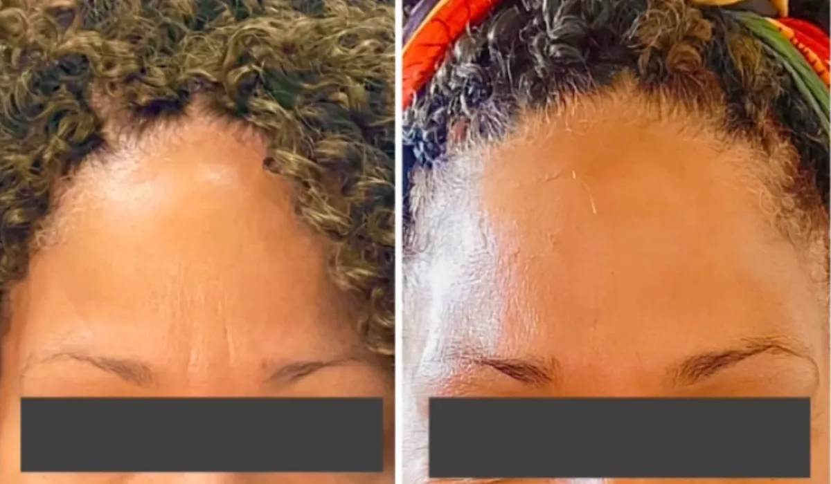 before and after injectables treatment at RedLands Body Sculpting with Dr. Aya in California