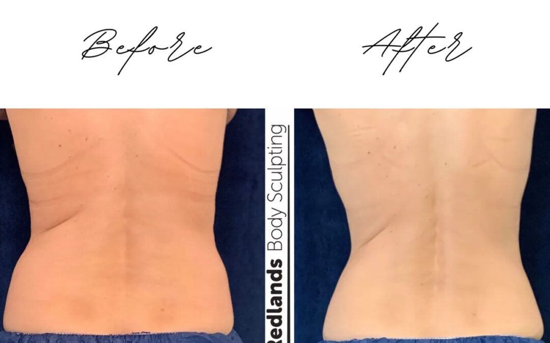 before and after love handles back coolsculpting treatment at RedLands Body Sculpting with Dr. Aya in California
