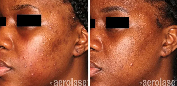 before and after neoclear acne treatment at RedLands Body Sculpting with Dr. Aya in California