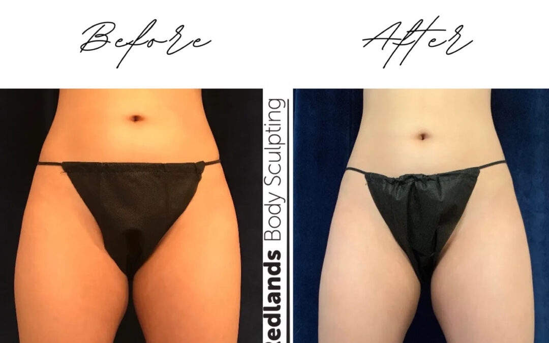 before and after thigh coolsculpting treatment at RedLands Body Sculpting with Dr. Aya in California