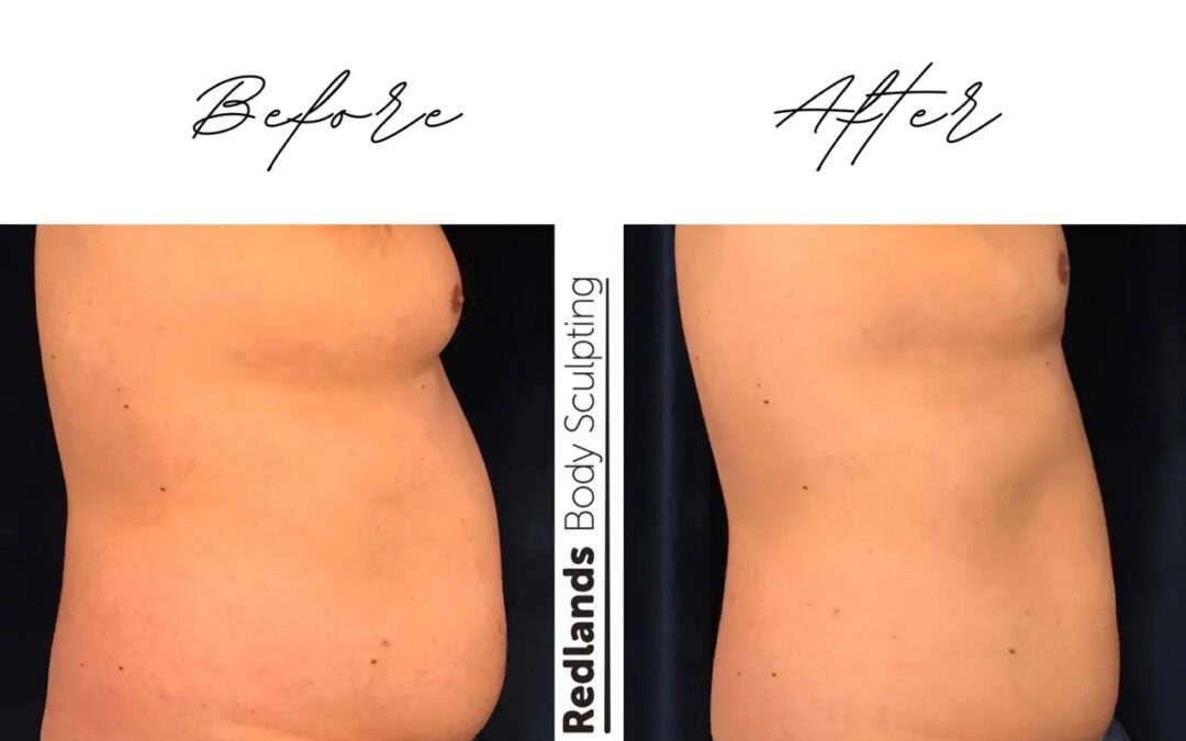 before and after abdomen coolsculpting treatment at RedLands Body Sculpting with Dr. Aya in California