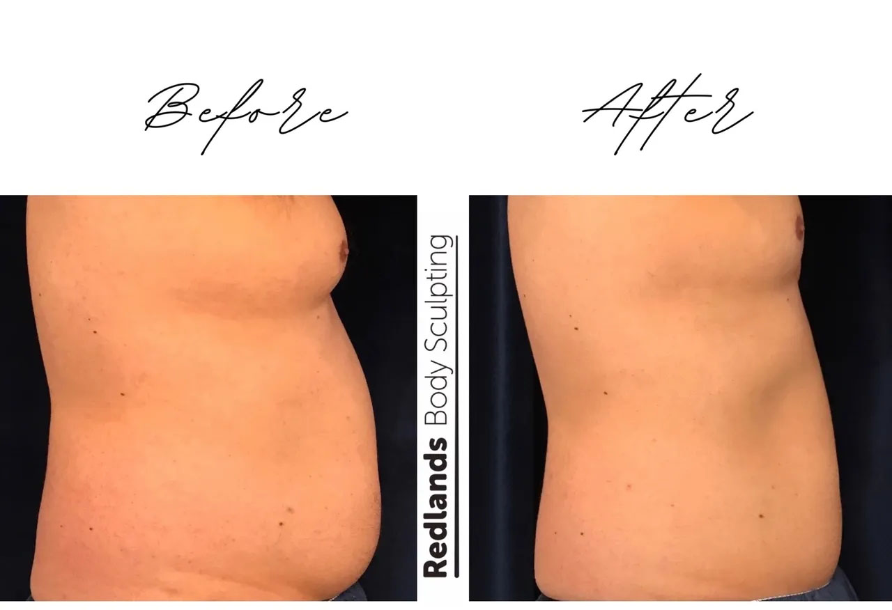 before and after abdomen coolsculpting treatment at RedLands Body Sculpting with Dr. Aya in California