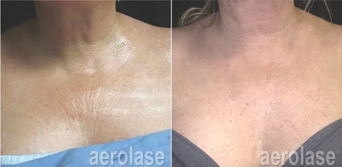 before and after aerolase laser treatment at RedLands Body Sculpting with Dr. Aya in California