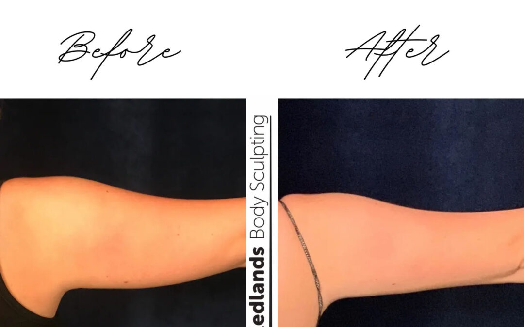 before and after arm coolsculpting treatment at RedLands Body Sculpting with Dr. Aya in California