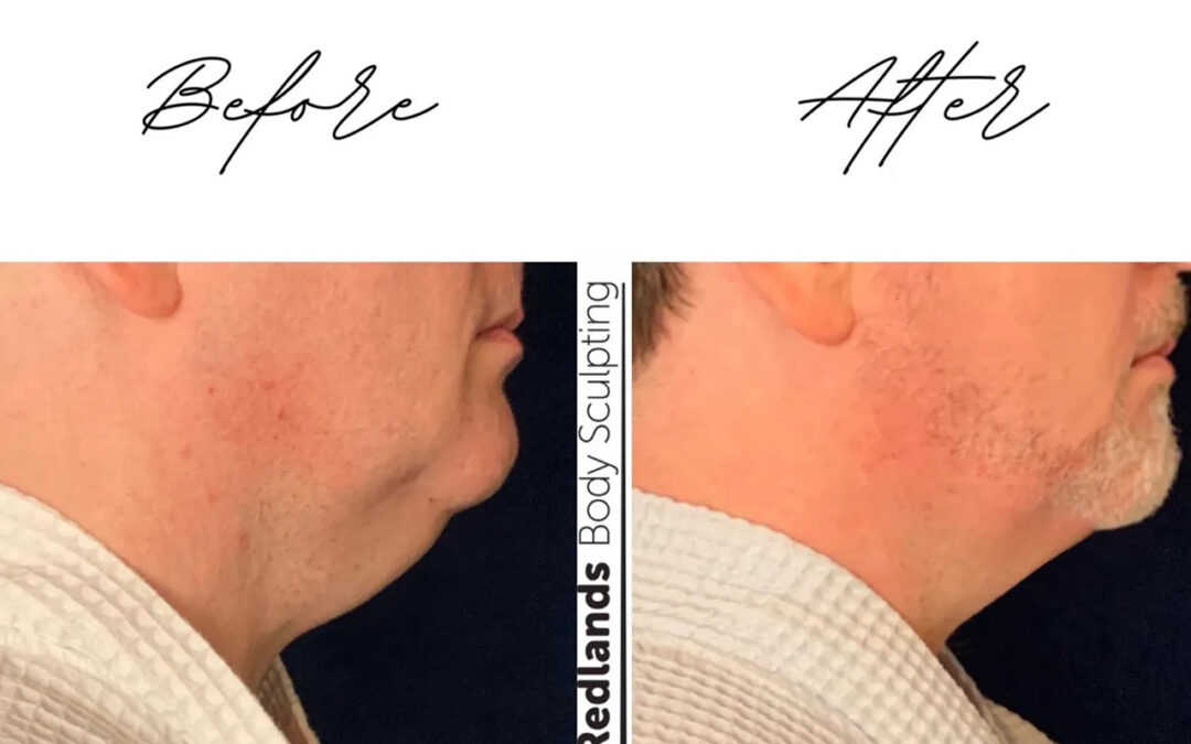 before and after chin coolsculpting treatment at RedLands Body Sculpting with Dr. Aya in California