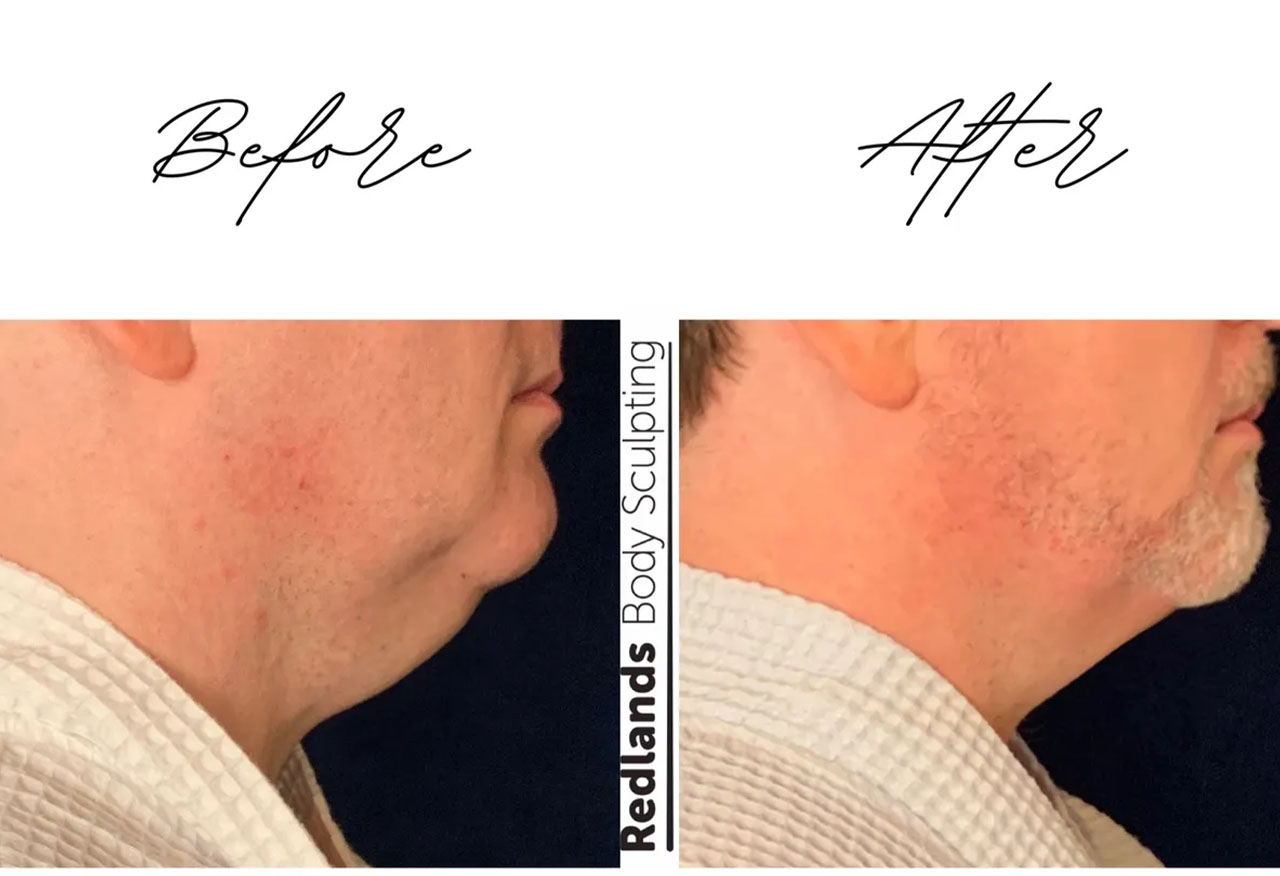 before and after chin coolsculpting treatment at RedLands Body Sculpting with Dr. Aya in California