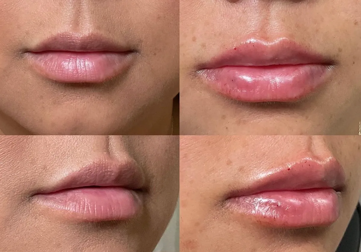 before and after injectables treatment at RedLands Body Sculpting with Dr. Aya in California