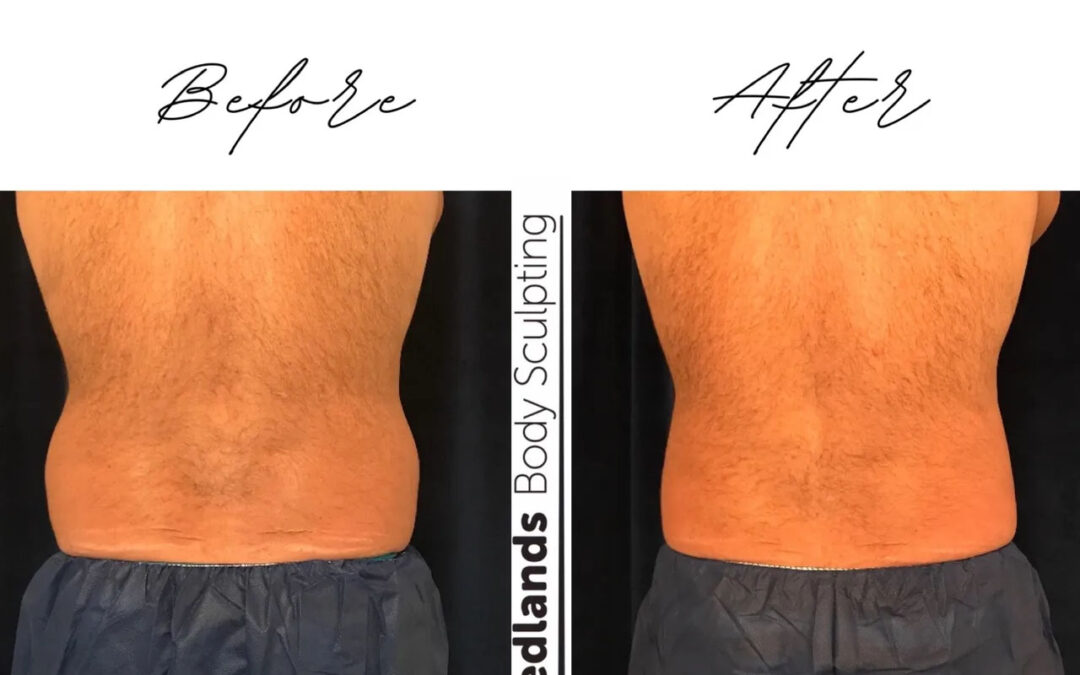 before and after love handles back coolsculpting treatment at RedLands Body Sculpting with Dr. Aya in California