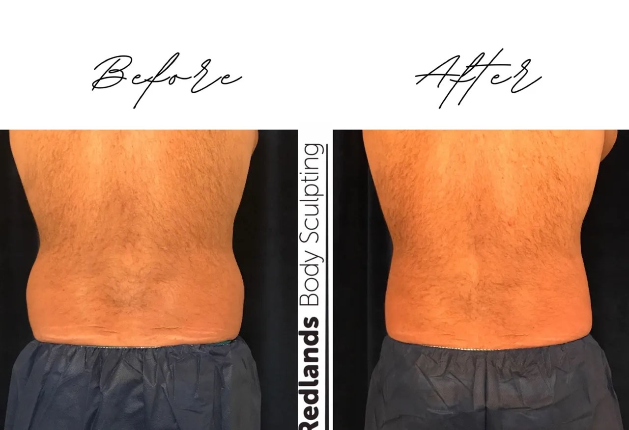 before and after love handles back coolsculpting treatment at RedLands Body Sculpting with Dr. Aya in California