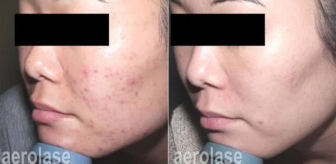 before and after neoclear acne treatment at RedLands Body Sculpting with Dr. Aya in California