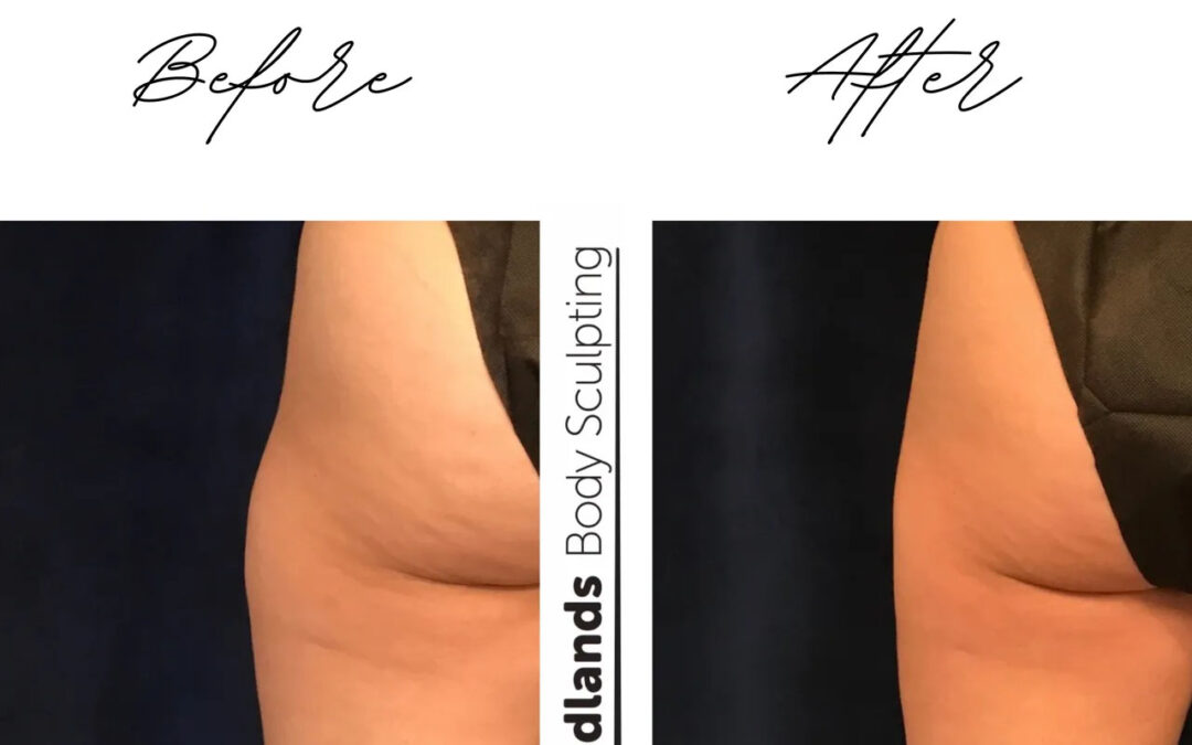before and after thigh coolsculpting treatment at RedLands Body Sculpting with Dr. Aya in California