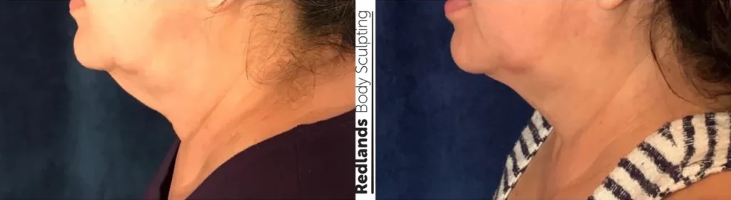 CoolSculpting Before and After photo by Redlands Body Sculpting in Redlands, CA