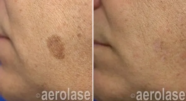 before and after aerolase laser treatment at RedLands Body Sculpting with Dr. Aya in California