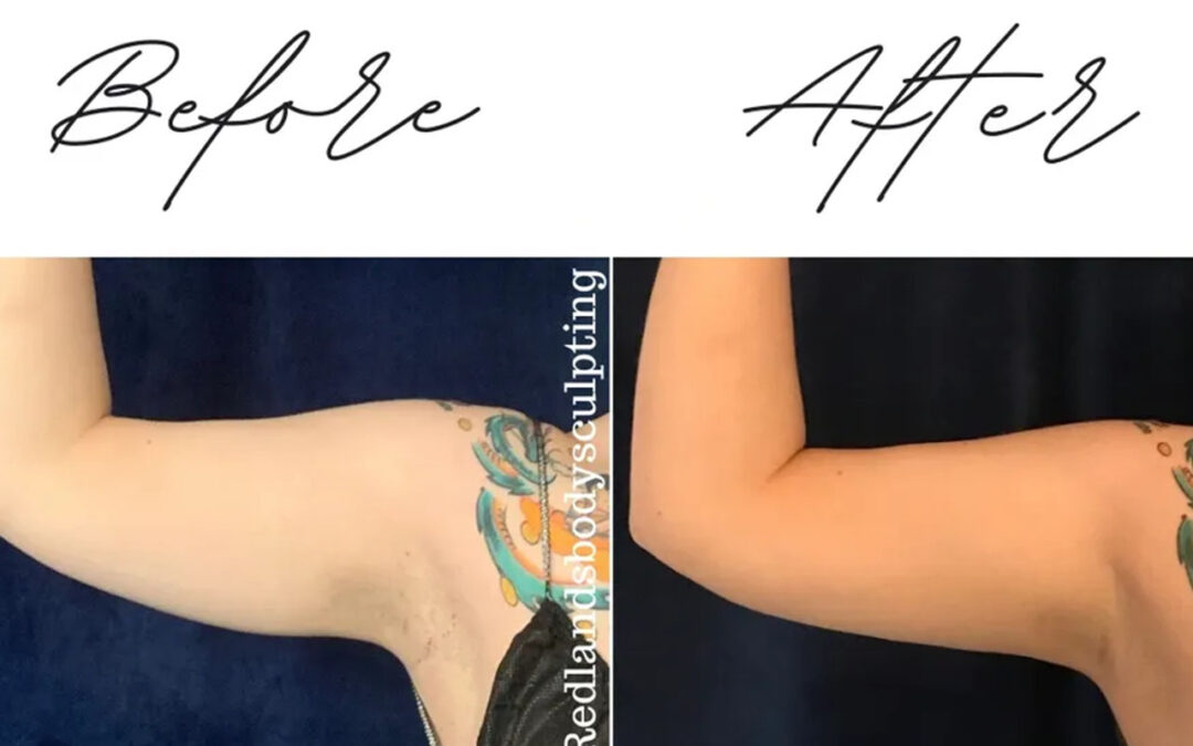 before and after arm coolsculpting treatment at RedLands Body Sculpting with Dr. Aya in California