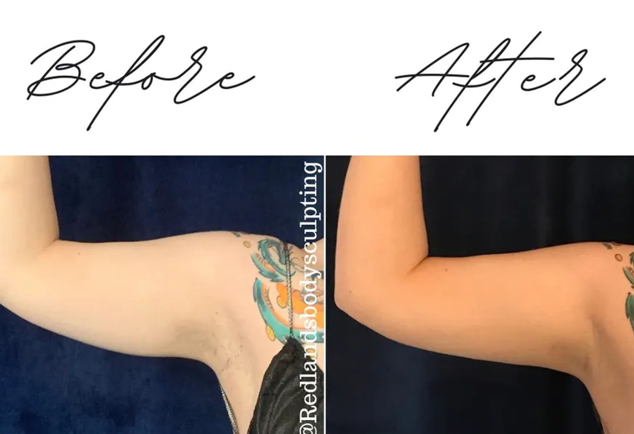 before and after arm coolsculpting treatment at RedLands Body Sculpting with Dr. Aya in California