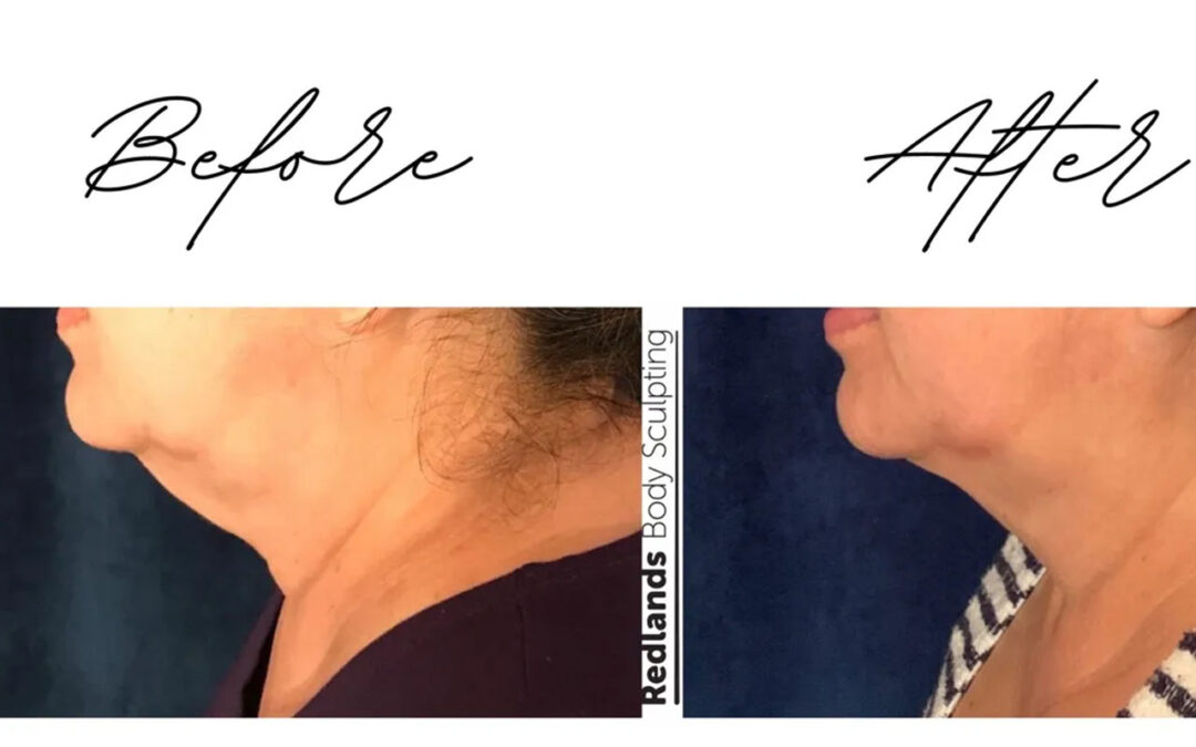 before and after chin coolsculpting treatment at RedLands Body Sculpting with Dr. Aya in California