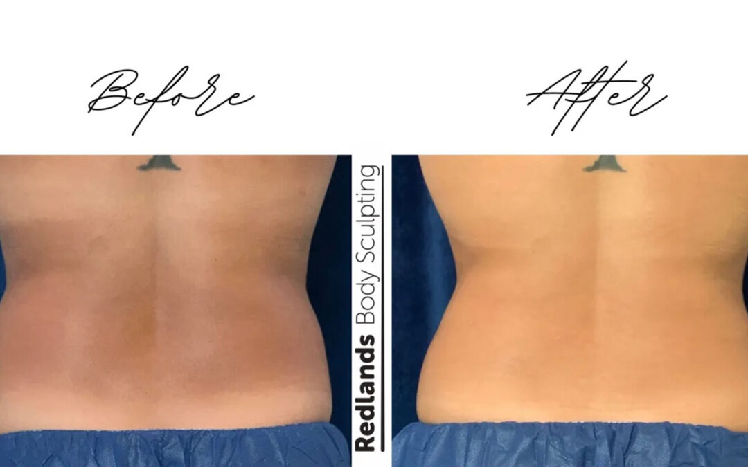 before and after love handles back coolsculpting treatment at RedLands Body Sculpting with Dr. Aya in California