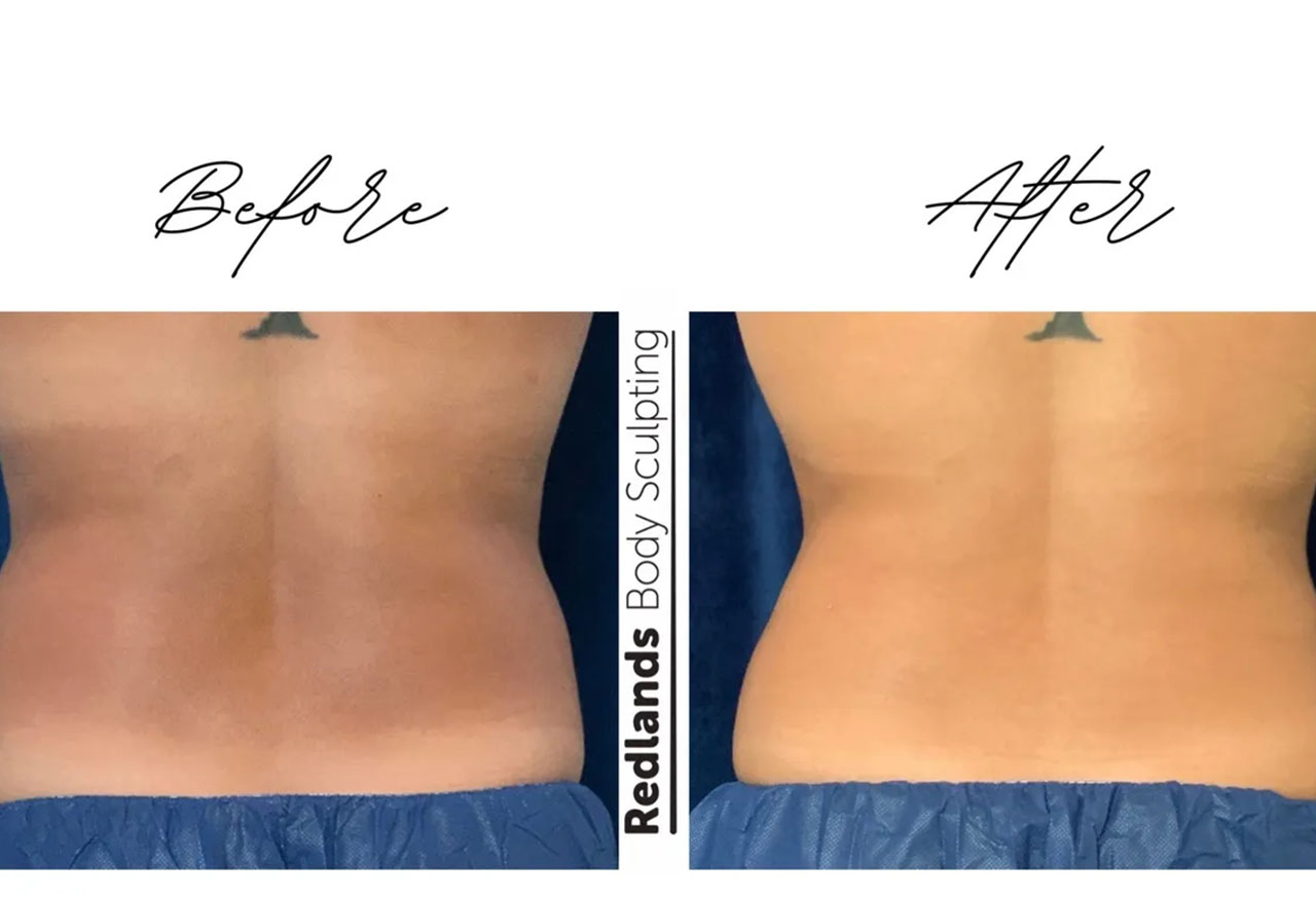 before and after love handles back coolsculpting treatment at RedLands Body Sculpting with Dr. Aya in California