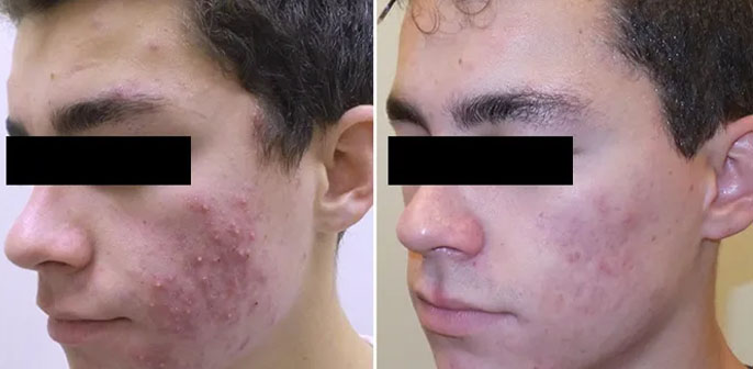 before and after neoclear acne treatment at RedLands Body Sculpting with Dr. Aya in California
