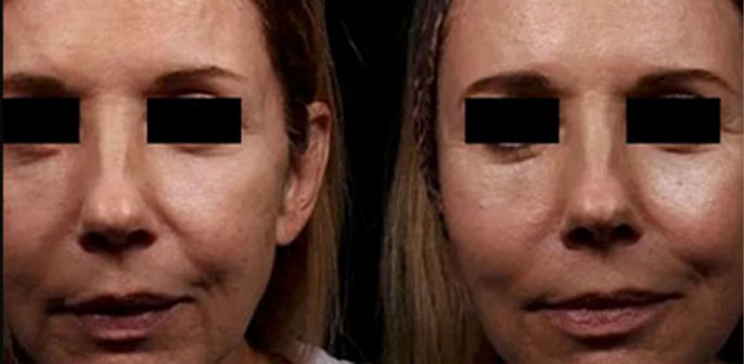 before and after neoskin treatment at RedLands Body Sculpting with Dr. Aya in California