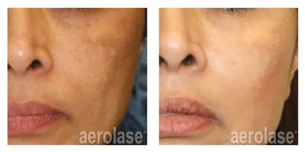 before and after aerolase laser treatment at RedLands Body Sculpting with Dr. Aya in California