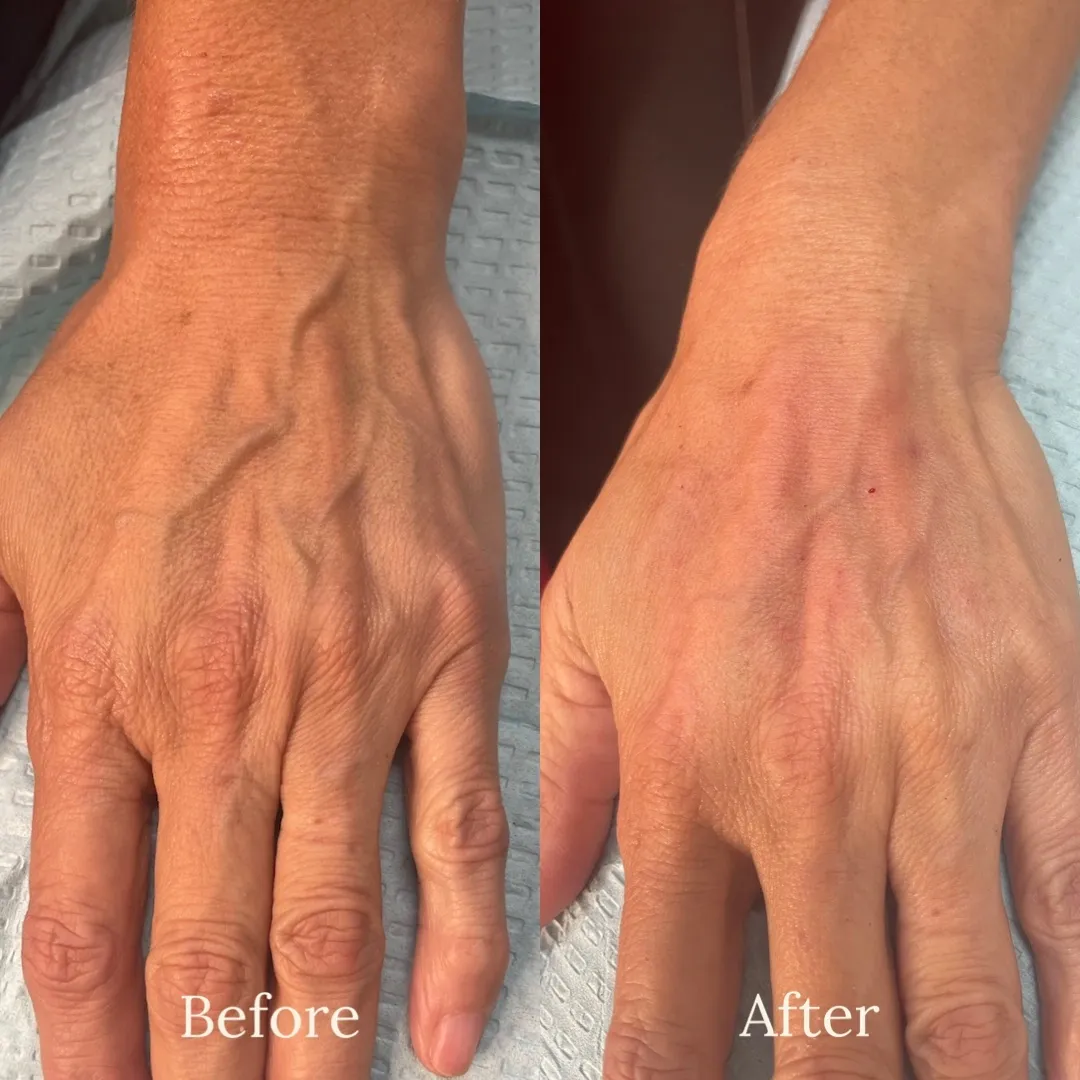before and after injectables treatment at RedLands Body Sculpting with Dr. Aya in California