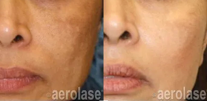 before and after neoskin treatment at RedLands Body Sculpting with Dr. Aya in California