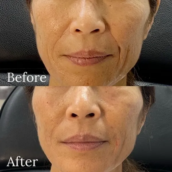 Dermal Filler Before and After photo by Redlands Body Sculpting in Redlands, CA