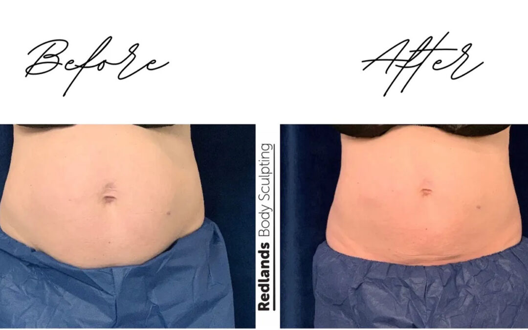 before and after abdomen coolsculpting treatment at RedLands Body Sculpting with Dr. Aya in California